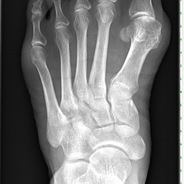 Vbočený palec (hallux valgus)